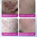 SADOER HYAKURONIC  ACNE PATCH SD17796 - Image 5