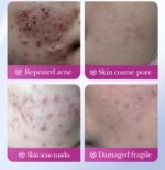 SADOER HYAKURONIC ACNE PATCH SD17796 - Image 5